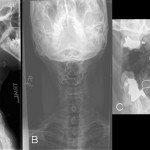 Fig. 3 Fig. 3 Twenty-year follow-up radiographs. Fig. 3-A Lateral cervical spine radiograph showing a large fusion mass with expansile, lytic changes involving C1-C3. Figs. 3-B and 3-C Anteroposterior and open-mouth odontoid radiographs demonstrating the same.
