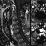 Fig. 4 Fig. 4 Twenty-year follow-up MRI. Fig. 4-A Sagittal T2-weighted image showing involvement of the posterior elements of C1-C3. Fig. 4-B Sagittal T1-weighted image with gadolinium showing the extension of the lesion into the body of C3. Figs. 4-C and 4-D Axial T2-weighted images at the level of C3 and C2, respectively, showing involvement of the vertebral bodies. MRI artifact is present posteriorly as a result of the wires used for the spinal fusion. 
