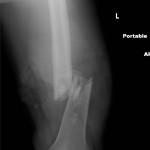 Fig. 1 An anteroposterior radiograph of the left femur showing a fracture of the femoral shaft with obvious soft-tissue disruption consistent with an open fracture.
