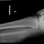 Fig. 2 A lateral radiograph of the left knee and tibia showing an ipsilateral patellar fracture associated with an open left femoral shaft fracture.
