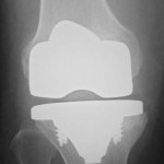 Fig. 1-A Preoperative radiograph showing calcific deposits in the lateral meniscus.
