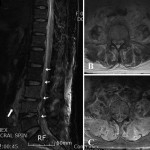 Fig. 2 Fig. 2 Preoperative MRI scans of the lumbar spine. Fig. 2-A Sagittal T2-weighted MRI showing the signal change of the L3 and L4 vertebral bodies and the extensive paravertebral mass perforating the anterior longitudinal ligament. The paravertebral mass displaces the inferior vena cava (thick arrow), and the epidural mass from L2 to L5 compresses the dural sac (thin arrows). Figs. 2-B and 2-C Axial T2-weighted and gadolinium-enhanced T1-weighted MRI showing extensive psoas and retroperitoneal involvement.
