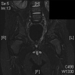 Fig. 1 Coronal STIR (short tau inversion recovery) MRI. 
