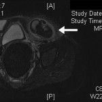 Fig. 2 Axial T2-weighted MRI showing a large heterogeneous mass (arrow) in the left inguinal region.
