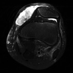 Fig. 1-A An axial T2-weighted MRI view shows a heterogeneous fluid collection along the anteromedial aspect of the knee.
