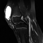 Fig. 1-B A sagittal T2-weighted MRI view shows a heterogeneous fluid collection along the anteromedial aspect of the knee.
