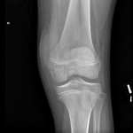 Fig. 3-A An anteroposterior radiograph of the knee revealing no fracture or other osseous abnormality. 
