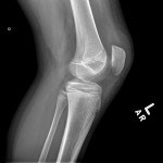 Fig. 3-B A lateral radiograph of the knee revealing no fracture or other osseous abnormality.
