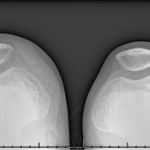 Fig. 3-C A Merchant radiograph of the knee revealing no fracture or other osseous abnormality. Anteromedial soft-tissue swelling is noted on the left.
