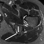 Fig. 1 Axial fluid-sensitive MRI demonstrating the partial tear of the proximal hamstring origin at the ischial tuberosity. The long arrow indicates the elongated, partially torn semimembranosus tendon, with abnormal fluid around the ischial tuberosity. The short arrow points to the posterior cortex of the ischial tuberosity.
