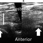 Fig. 2 Still images from a dynamic ultrasound study with the patient standing erect (Fig. 2-A) and with full hip flexion (Fig. 2-B), with the ultrasound probe over the gluteal region. The short arrow indicates the ischial tuberosity cortex at the hamstring origin. The long arrow indicates the medially subluxated, partially torn tendon.
