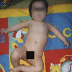 Fig. 1-A At the patient’s first visit to our clinic, at the age of three months, the waiter’s-tip position of the upper extremity is seen.
