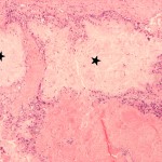 Fig. 4 Photomicrograph of a tissue specimen from the shoulder, demonstrating deposits (stars) surrounded by granulomatous infiltrates consisting of multinucleated giant cells and histiocytes (hematoxylin and eosin; original magnification, ×40).
