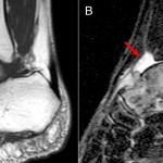 Fig. 2 Fig. 2-A Sagittal T1-weighted magnetic resonance image revealing a lesion with low signal intensity. The lesion extends from the talar head to the talar neck, and the low signal area extends beyond what seemed to be the posterior margin of the tumor. Fig. 2-B Short tau inversion recovery (STIR) image showing high signal intensity of the whole talus. An ankle joint effusion can be seen (arrow).
