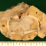 Fig. 4 Photograph of the resected specimen. The tumor appears to have originated from the neck of the talus. The talus was resected, along with the distal end of the tibia (T), the navicular (N), part of the cuboid, and the subtalar joint (C = calcaneus). The margins were histologically free of tumor.
