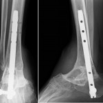 Fig. 5 Anteroposterior (left) and lateral (right) radiographs, made three years after surgery, showing bridging bone formation between the tibia and the medial cuneiform.
