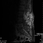 Fig. 1 Sagittal T1-weighted gadolinium-enhanced magnetic resonance imaging scan of the lumbar spine, showing a lesion extending from L2 to the sacrum, measuring 10.8 cm at the greatest diameter and involving both soft-tissue and osseous elements.
