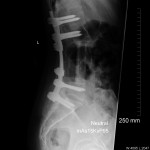 Fig. 4 Lateral radiograph of the lumbar spine, made five years postoperatively, demonstrating incorporation of the humeral allograft and maintenance of sagittal alignment.
