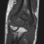 Fig. 2-A Coronal T1-weighted magnetic resonance image of the elbow, made before the administration of gadolinium, showing an abnormal bone marrow-infiltrating process of the distal humeral metaphysis and epiphysis with low signal.
