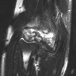 Fig. 2-B Coronal T2-weighted magnetic resonance image, made before the administration of gadolinium, exhibiting high T2 signal in the distal part of the humerus.
