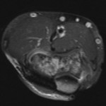 Fig. 2-C Axial T1-weighted magnetic resonance image, made after the administration of gadolinium, showing patchy enhancement of the distal part of the humerus.
