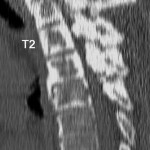 Fig. 1-B Sagittal computed tomographic reconstruction of the thoracic spine, demonstrating severe spinal stenosis of the upper thoracic spine.

