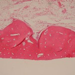 Fig. 3 Section from the intraoperative specimen demonstrating mature lamellar and reactive bone (hematoxylin and eosin, original magnification ×10).
