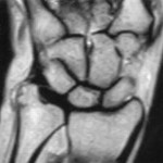 Fig. 2 T1-weighted magnetic resonance image of the distal aspect of the ulna, showing nonspecific expansion of the ulnar styloid with no obvious mass.
