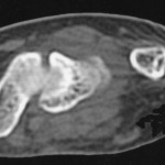 Fig. 3 Axial computed tomographic image showing the cortical irregularity of the distal aspect of the ulna. Enlargement of the ulnar styloid process can be seen to the right.
