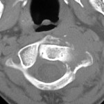 Fig. 1 Axial computed tomography scan showing an osteolytic lesion in the left lateral mass of the atlas.
