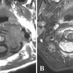 Fig. 2 Axial magnetic resonance imaging scans showing an isointensive mass on the T1-weighted image (Fig. 2-A) and a high-intensity mass on the T2-weighted image (Fig. 2-B).
