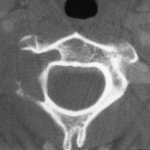 Fig. 1 Computed tomographic image shows a lytic lesion involving the right aspect of the odontoid process, the right lateral mass of the second cervical vertebra, and the foramen transversarium. Note the lateral cortical destruction and associated soft-tissue mass displacing the vertebral artery (arrow) laterally.
