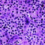 Fig. 4-B Photomicrograph of cellular region shows mononuclear cells with round to oval nuclei. Most of the cells have a pale vesiculated cytoplasm. Two multinucleated osteoclast-type giant cells are also present (hematoxylin and eosin, ×600).
