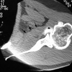 Fig. 1-A The original computed tomographic arthrogram showing an excessively thick subscapularis muscle. The arrows delineate the anterior border of the subscapularis.
