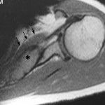 Fig. 1-B A T1-weighted magnetic resonance imaging scan showing the mass (asterisk) within the subscapularis. The arrows delineate the anterior border of the subscapularis.
