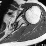Fig. 1-C A magnetic resonance imaging scan made two years after the initial tumor resection confirming the recurrence. The asterisk marks the mass.
