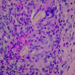 Fig. 1 Hip capsule tissue with many eosinophils (hematoxylin and eosin; original magnification, ×200).
