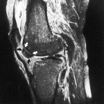 Fig. 1 Fast-spin-echo T2-weighted sagittal image of the right knee, showing a low-signal-intensity intra-articular substance (arrows) with effusion. There is diffuse edema of the soft tissues around the joint. The marrow signal is normal.
