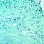 Fig. 2-C Histopathological findings on biopsy of synovial fluid from the right knee joint. Low-power image. The upper portion shows round-to-oval bodies staining black (arrows) on a background of loose tissue (Grocott stain, ×100).
