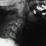 Fig. 1 Preoperative lateral radiograph of the cervical spine, revealing a 25% anterior spondylolisthesis of the third on the fourth cervical vertebra and a 50% anterior spondylolisthesis of the fourth on the fifth cervical vertebra.
