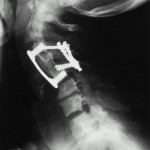 Fig. 3 Postoperative lateral radiograph of the cervical spine, made after anterior and posterior stabilization.
