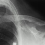 Fig. 5 Anteroposterior radiograph of the left clavicle, demonstrating distal resorption with widening of the acromioclavicular joint.
