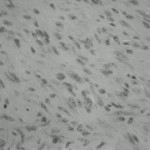 Fig. 2 Histological section showing interlacing bundles of spindle cells with plump nuclei in sheets (hematoxylin and eosin, ×40).
