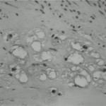 Fig. 3 Histological section showing scattered foci of chondroid differentiation (hematoxylin and eosin, ×40).
