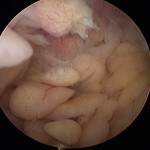 Fig. 4 Arthroscopic appearance of villous proliferation of the synovial membrane in the suprapatellar pouch.
