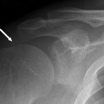 Fig. 1 A plain anteroposterior radiograph of the shoulder, showing a faint amorphous opacity (arrow) above the humeral head.
