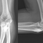 Fig. 1 Anteroposterior (left) and lateral (right) radiographs demonstrating cortical hyperostosis of the proximal part of the ulna and specked calcification of the triceps insertion.
