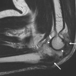 Fig. 3 T2-weighted sagittal magnetic resonance image showing areas of low signal intensity, indicating bone changes (long arrows). The articular cartilage (arrowheads) is intact.
