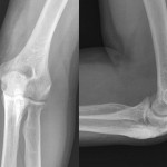 Fig. 5 Anteroposterior (left) and lateral (right) radiographs showing no recurrence of pathologic bone two years after the operation.
