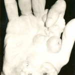 Fig. 1-A Photograph of the right hand, showing nodular lesions and overlying skin ulcerations.
